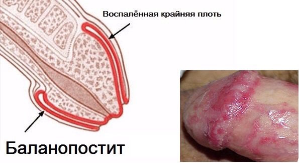 баланит баланопостит